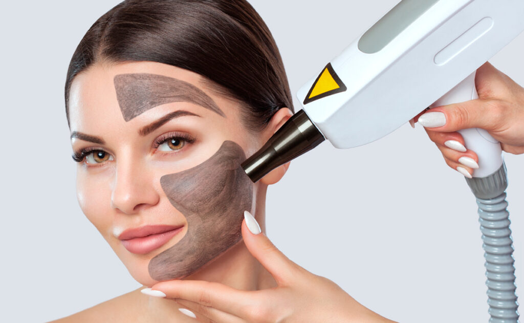 hollywood peel mascarilal de carbon, rejuvenecimineto facial con laser